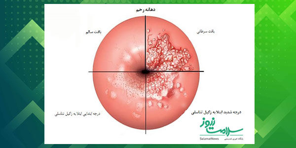 زگیل تناسلی چیست و چگونه درمان میشود؟