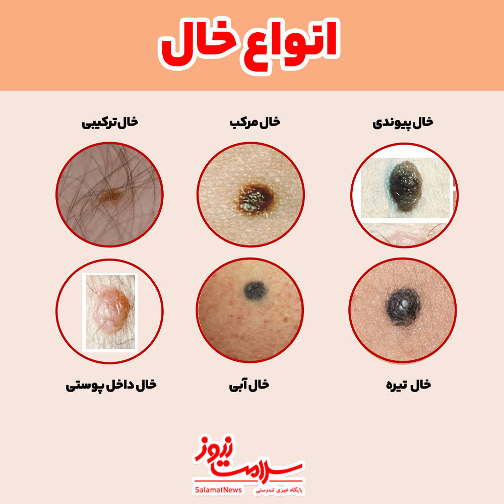 بزرگ شدن خال گوشتی نشانه چیست؟