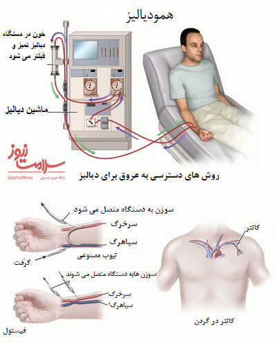 هر چیزی که درباره دیالیز باید بدانید
