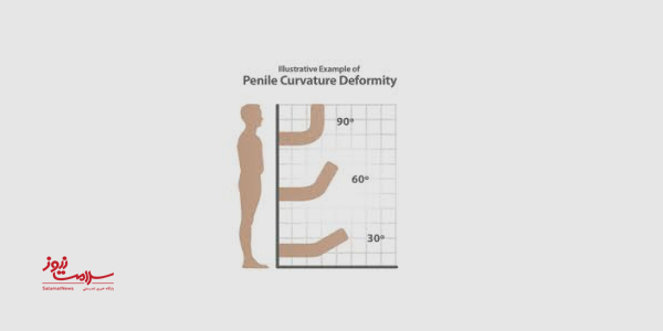 علت انحنای آلت تناسلی چیست و چه علائمی دارد؟