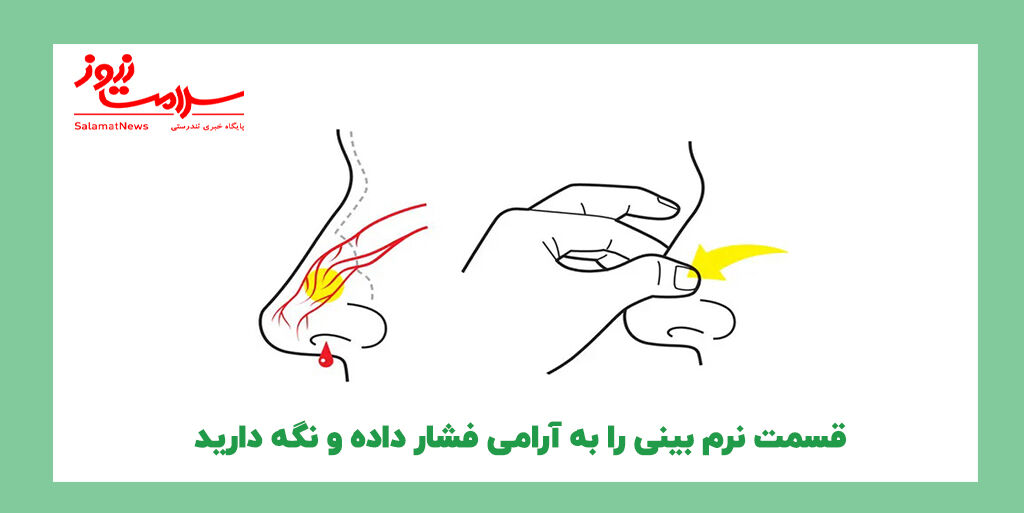 خونریزی بینی