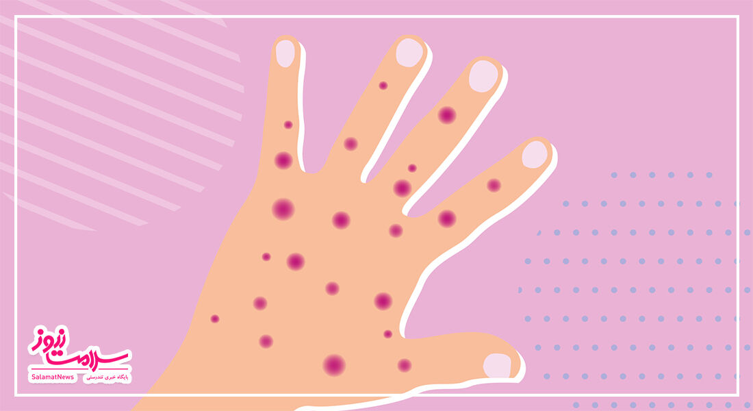 آبله میمونی برای چه افرادی خطرناکتر است؟ آبله میمونی برای چه افرادی خطرناکتر است؟