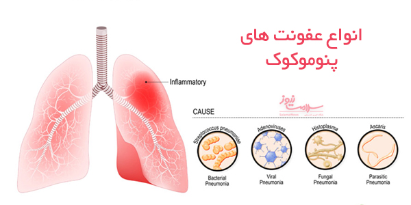 انواع،تشخیص ،ایمن سازی بیماری های پنوموکوک