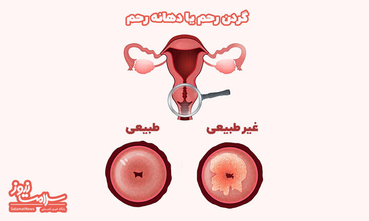 آزمایش پاپ اسمیر چه زمانی باید انجام شود؟