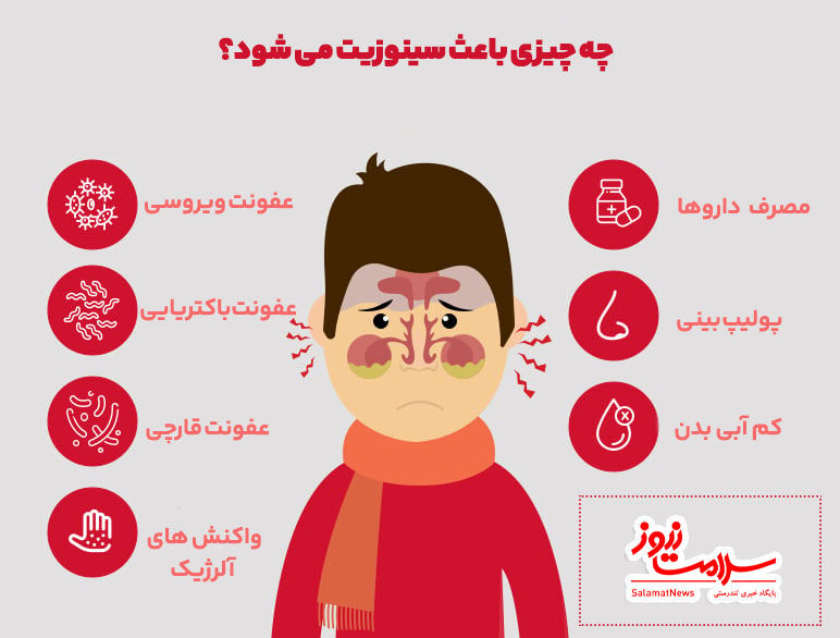 سینوزیت