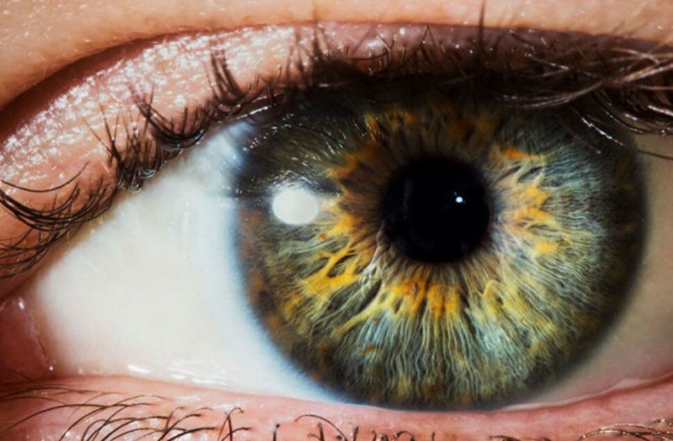 قوز قرنیه درمان قطعی ندارد قوز قرنیه درمان قطعی ندارد