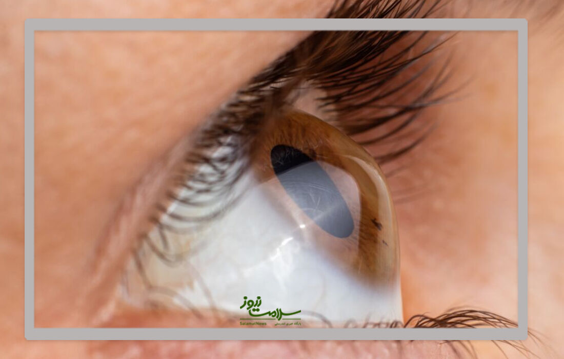قوز قرنیه چگونه به وجود می آید؟ قوز قرنیه چگونه به وجود می آید؟