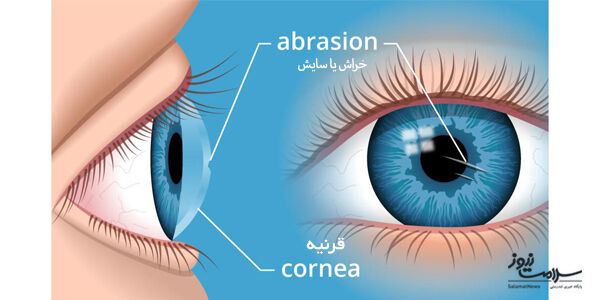 قوز قرنیه چگونه به وجود می آید؟