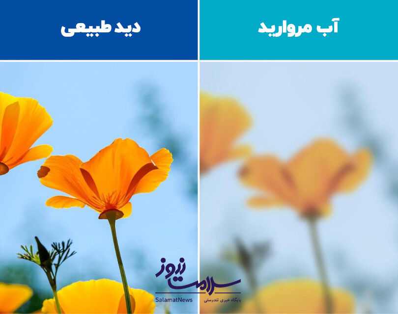 دید آب مروارید