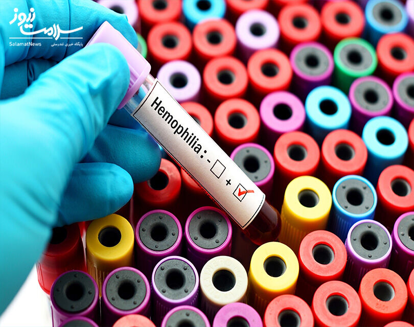 خونریزیهایی که نشانه هموفیلی هستند خونریزیهایی که نشانه هموفیلی هستند