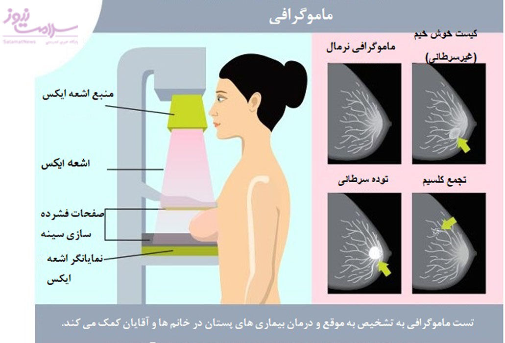 ماموگرافی چرا و چگونه انجام می شود؟