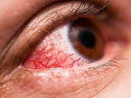 5 گام برای پیشگیری از بیماری چشمی ناشی از دیابت