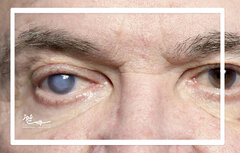 کارایی داروی التهاب روده برای چشم