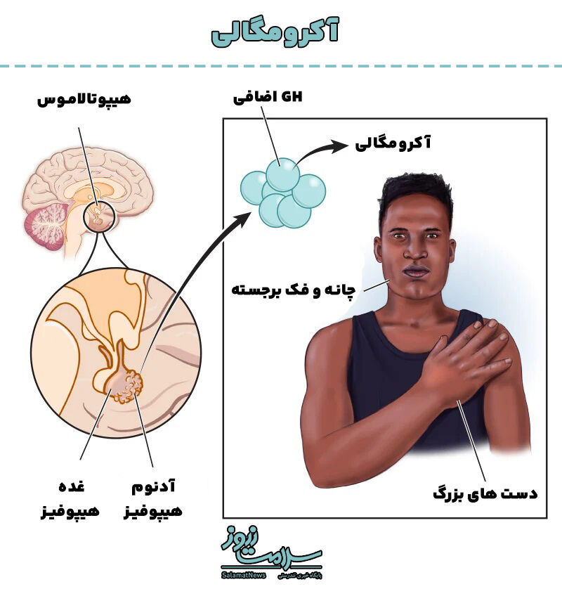 آکرومگالی