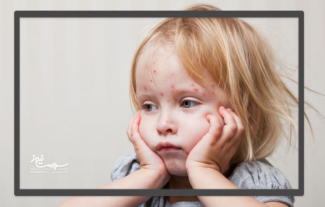 سرخک چیست، چه علائمی دارد و چگونه درمان میشود؟ سرخک چیست، چه علائمی دارد و چگونه درمان میشود؟
