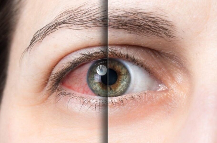 ۵ روش درمان خشکی چشم
