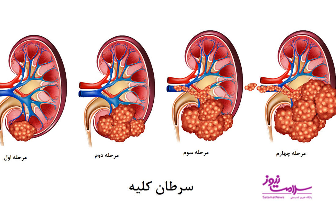 سرطان کلیه ، پیشگیری،تشخیص و درمان