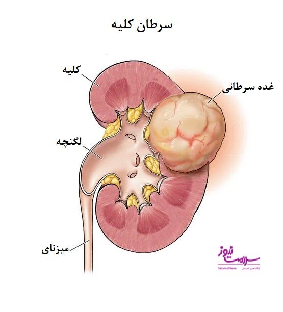 سرطان کلیه ، پیشگیری،تشخیص و درمان