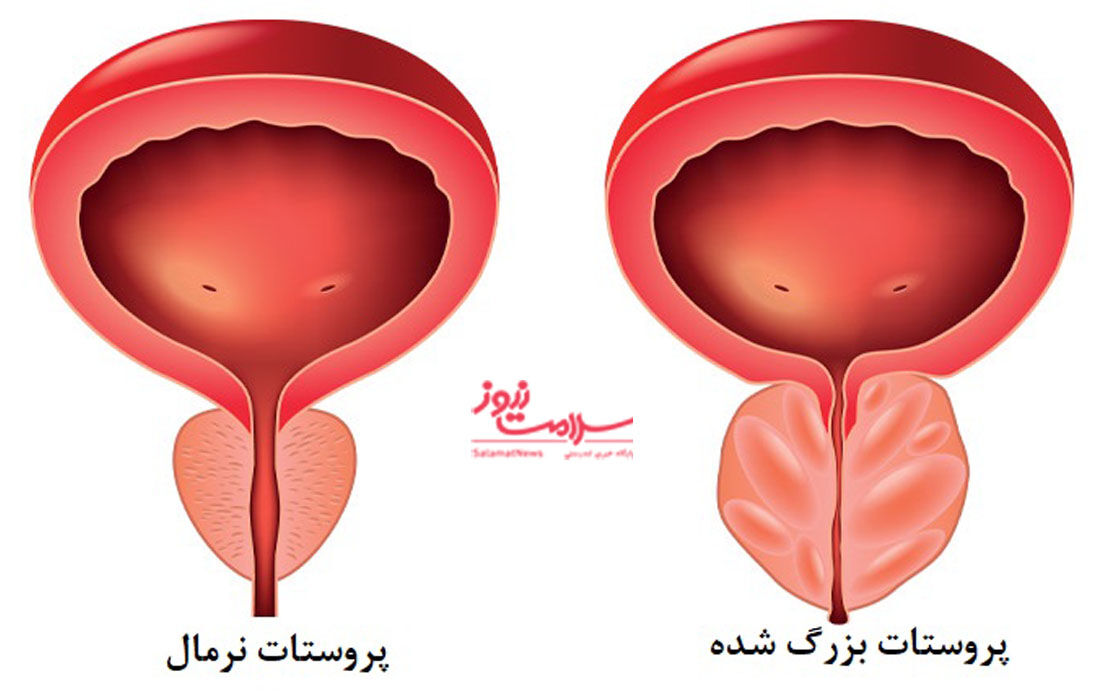 علائم، تشخیص و درمان سرطان پروستات علائم، تشخیص و درمان سرطان پروستات