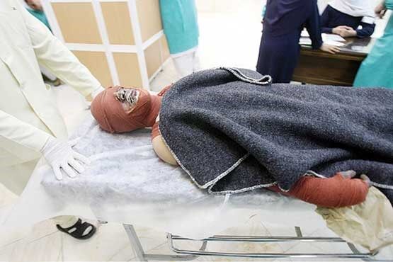 قربانیان سوختگی در ایران از متوسط جهانی بالاتر است قربانیان سوختگی در ایران از متوسط جهانی بالاتر است