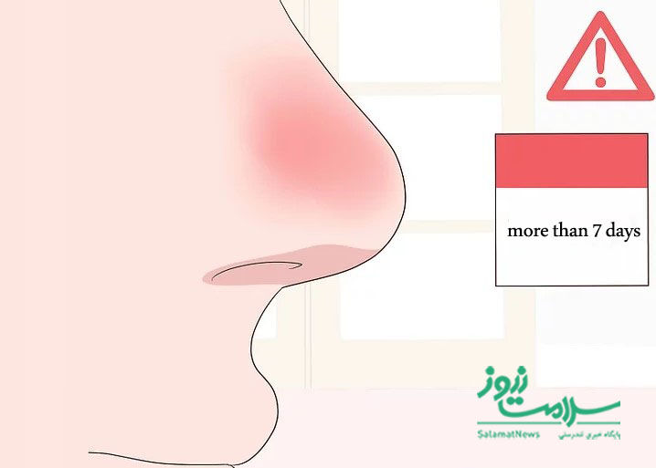 9 ترفند ساده برای درمان فوری گرفتگی بینی