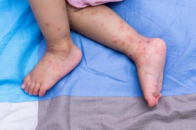 جزئیاتی درباره شیوع بیماری "دست و پا و دهان" / کودکان اصلی‌ترین میزبان ویروس