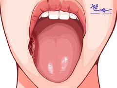 شکل ظاهری سرطان دهان/چه کسانی مبتلا می شوند؟