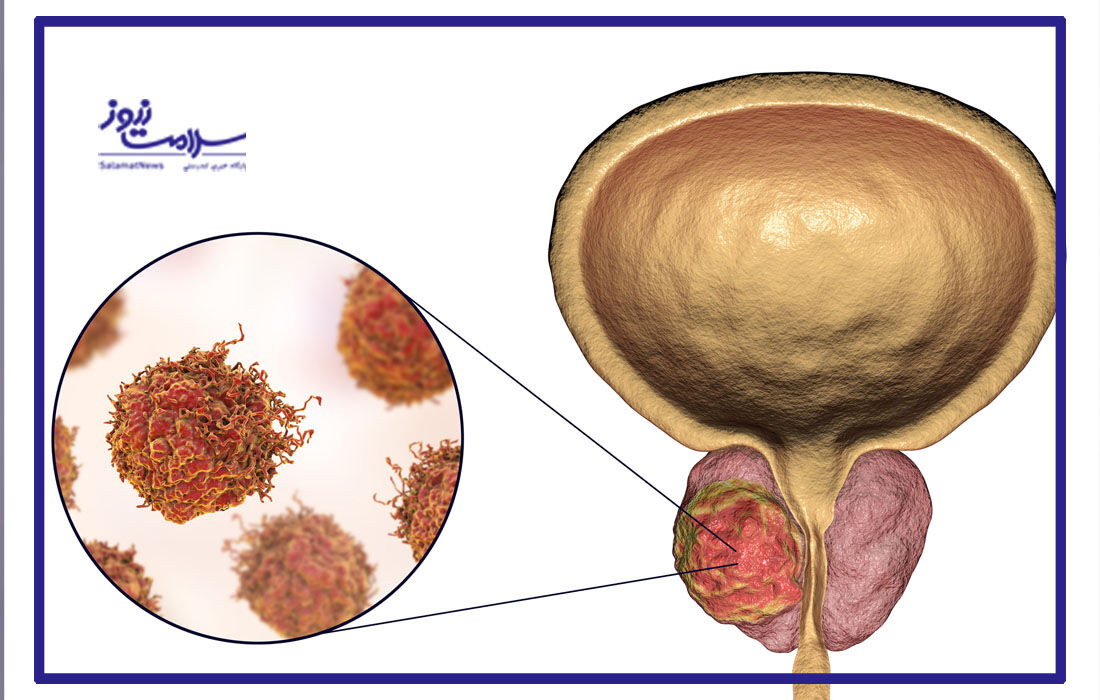 کمک به درمان سرطان پروستات با هدف قرار دادن یک پروتئین