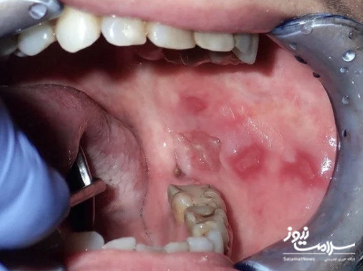 تشخیص،درمان و پیشگیری از سرطان دهان
