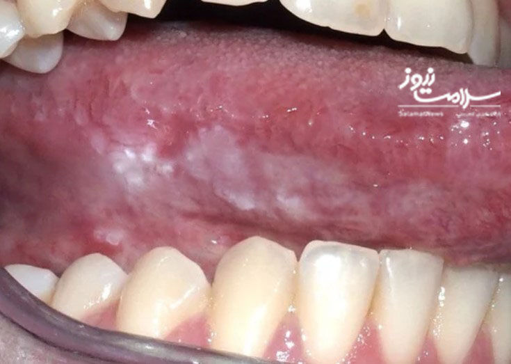 تشخیص،درمان و پیشگیری از سرطان دهان