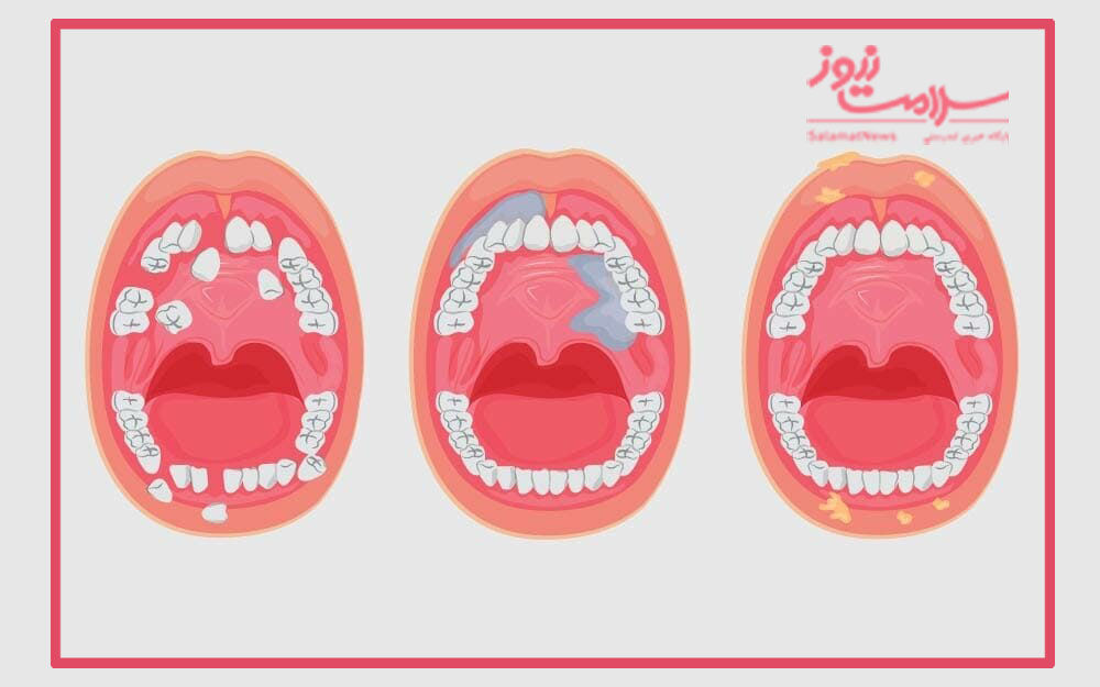علل و علایم سرطان دهان علل و علایم سرطان دهان