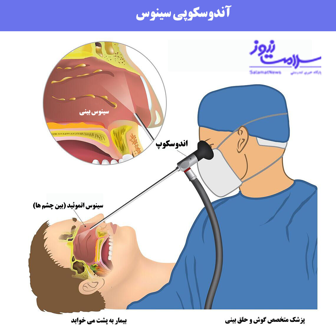 مراقبتهای قبل و بعد از آندوسکوپی سینوس ها