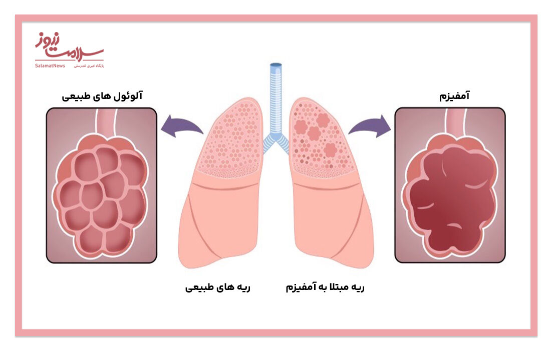 بیماری آمفیزم چیست؟