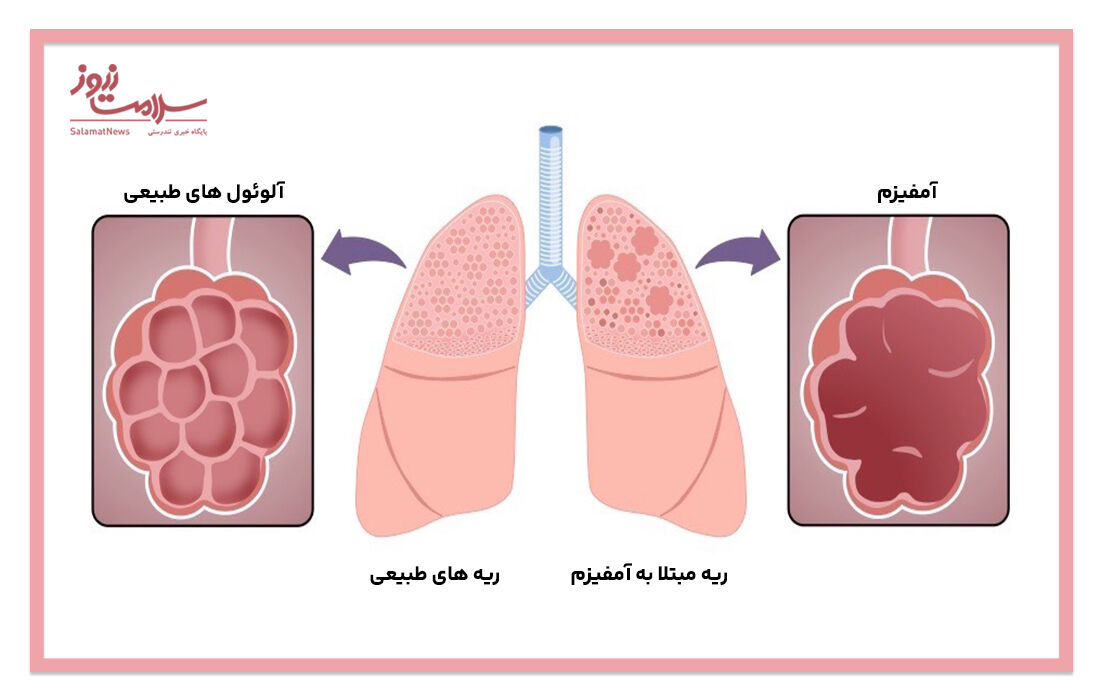 بیماری آمفیزم چیست؟ بیماری آمفیزم چیست؟