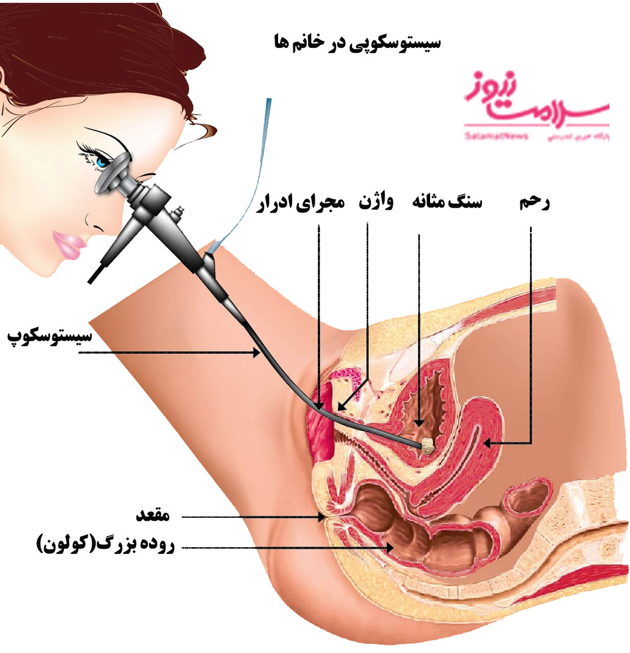 نکات مهم آمادگی برای سیستوسکوپی