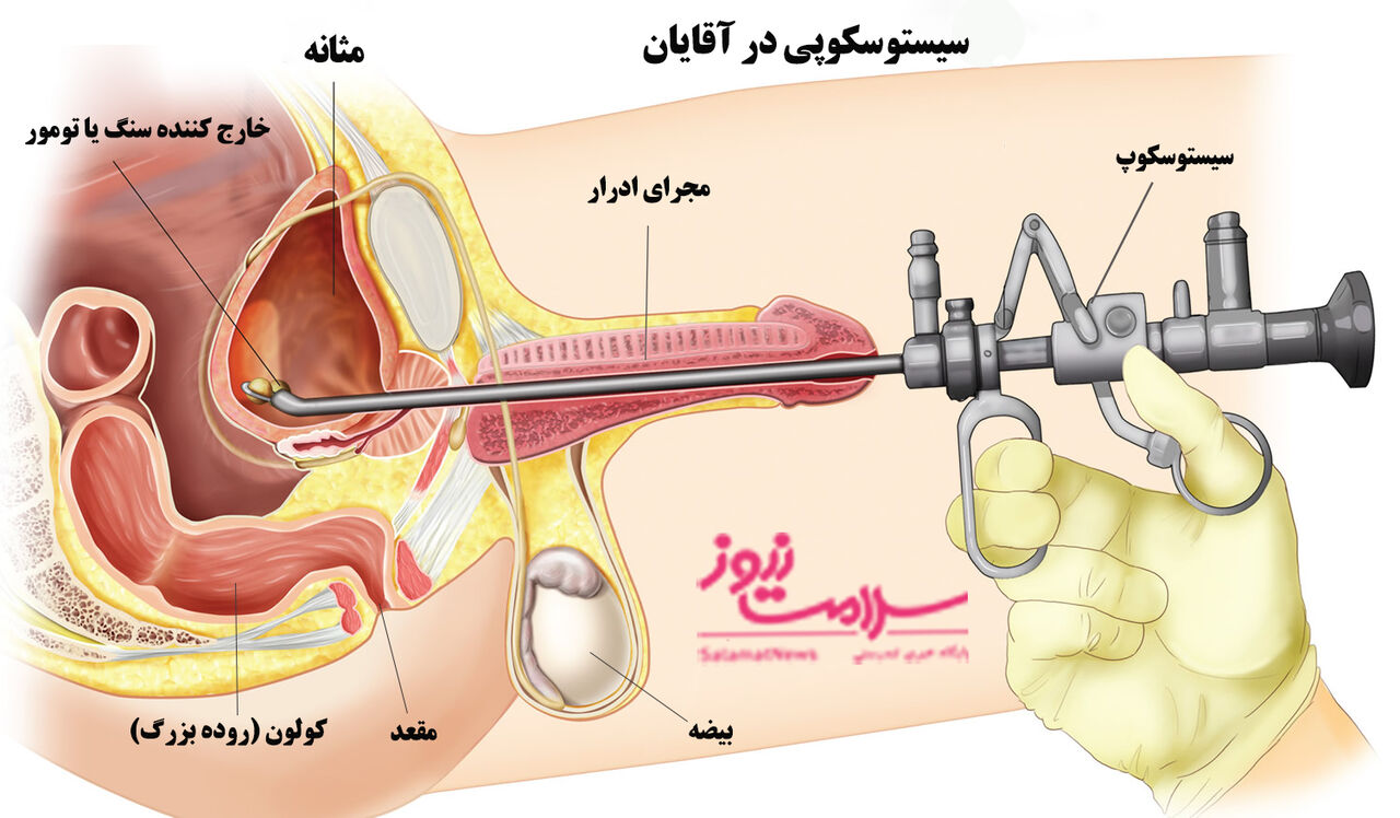 نکات مهم آمادگی برای سیستوسکوپی