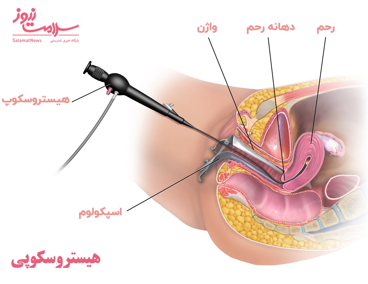 هیستروسکوپی
