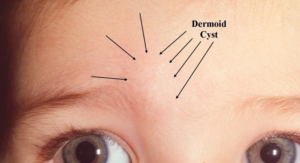 کیست درموئید: انواع، علائم و درمان کیست درموئید: انواع، علائم و درمان
