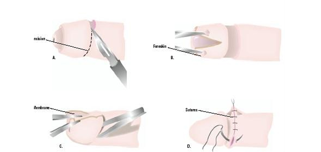 فواید ختنه برای سلامتی مردان