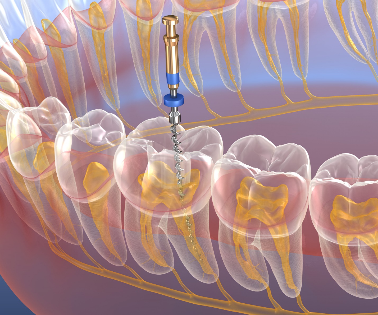همه چیز درباره درمان مجدد ریشه ی دندان