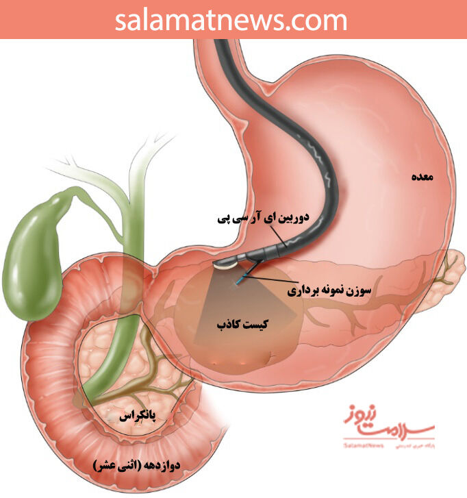 ای آر سی پی ( ERCP) چیست و چه کاربرد هایی دارد؟