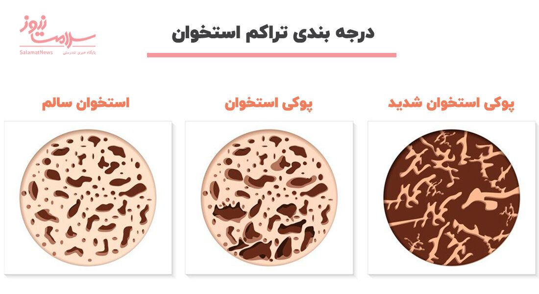 پوکی استخوان