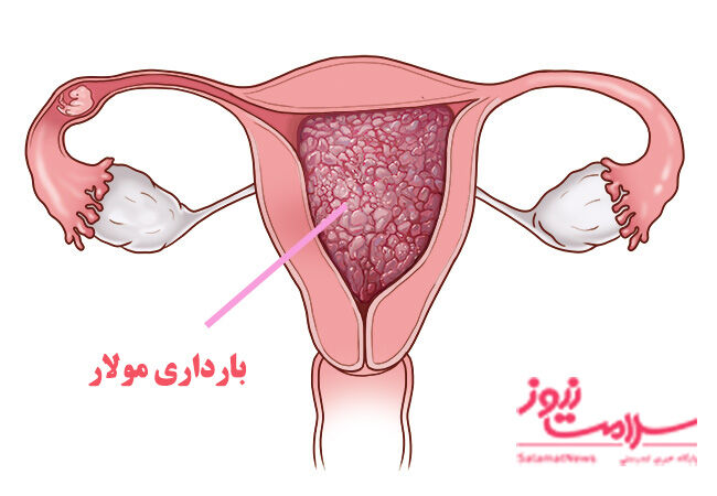 عکس/۱۴ علت لکهبینی در دوران بارداری