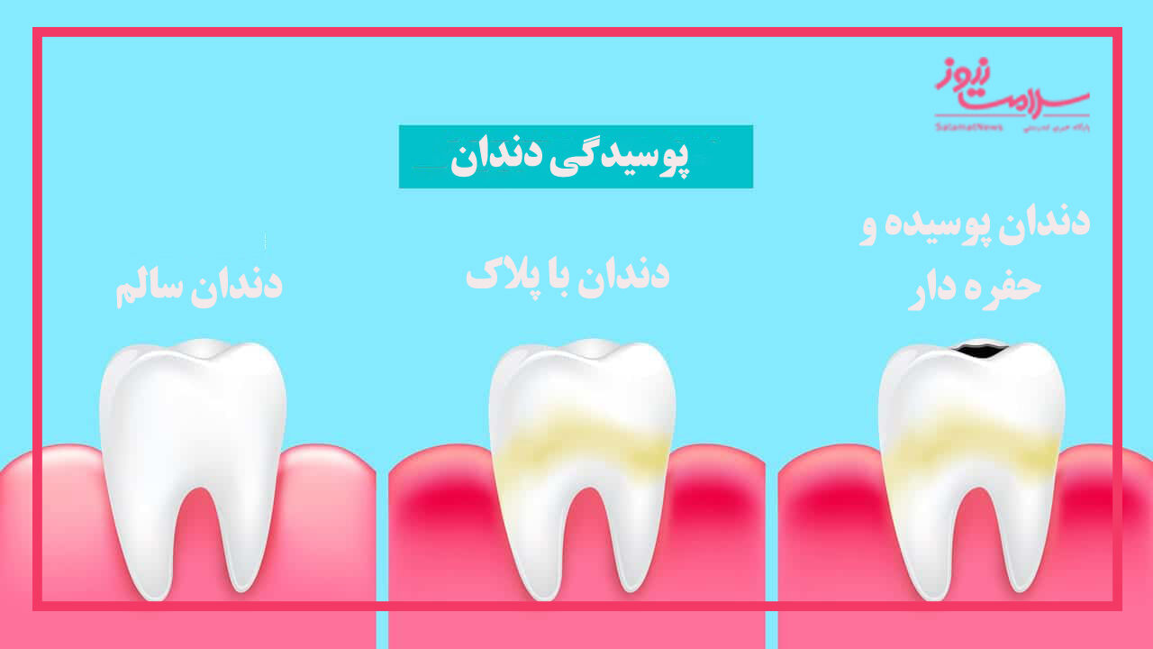 درمان زودهنگام پوسیدگی های دندان