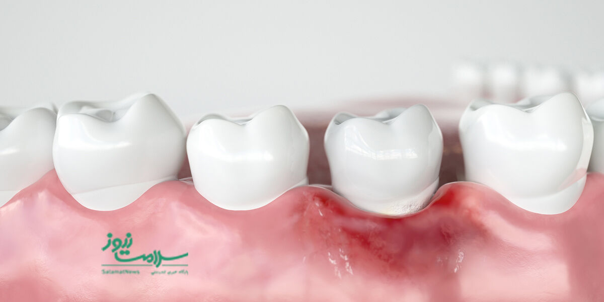 التهاب لثه چیست و چگونه درمان می شود؟ التهاب لثه چیست و چگونه درمان می شود؟