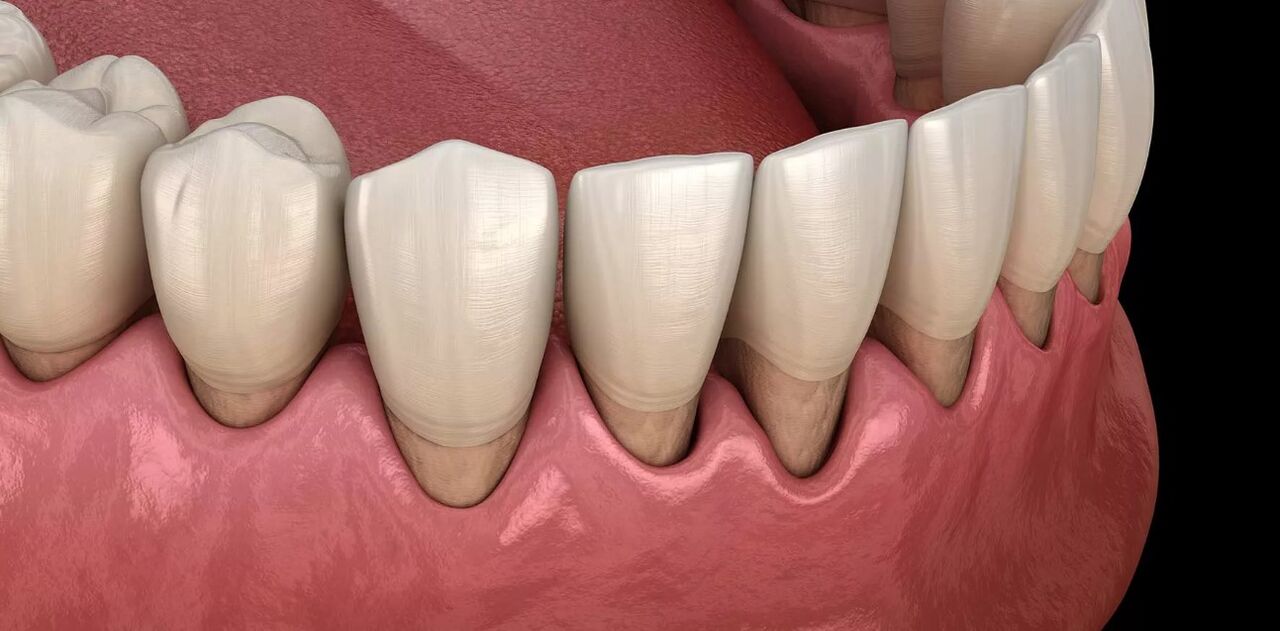 بیماری پریودنتال چیست؟ بیماری پریودنتال چیست؟