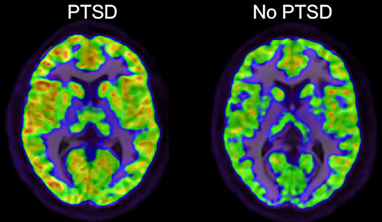 اختلال استرس پس از سانحه یا PTSD