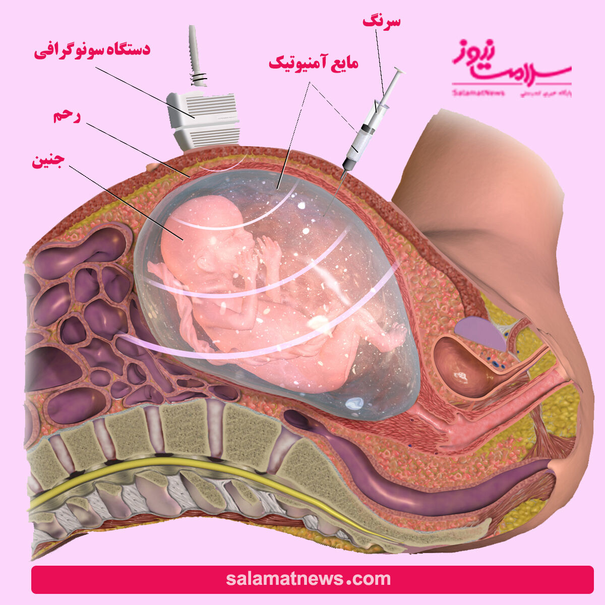 آمنیوسنتز چیست و برای کدام زنان باردار باید انجام شود؟