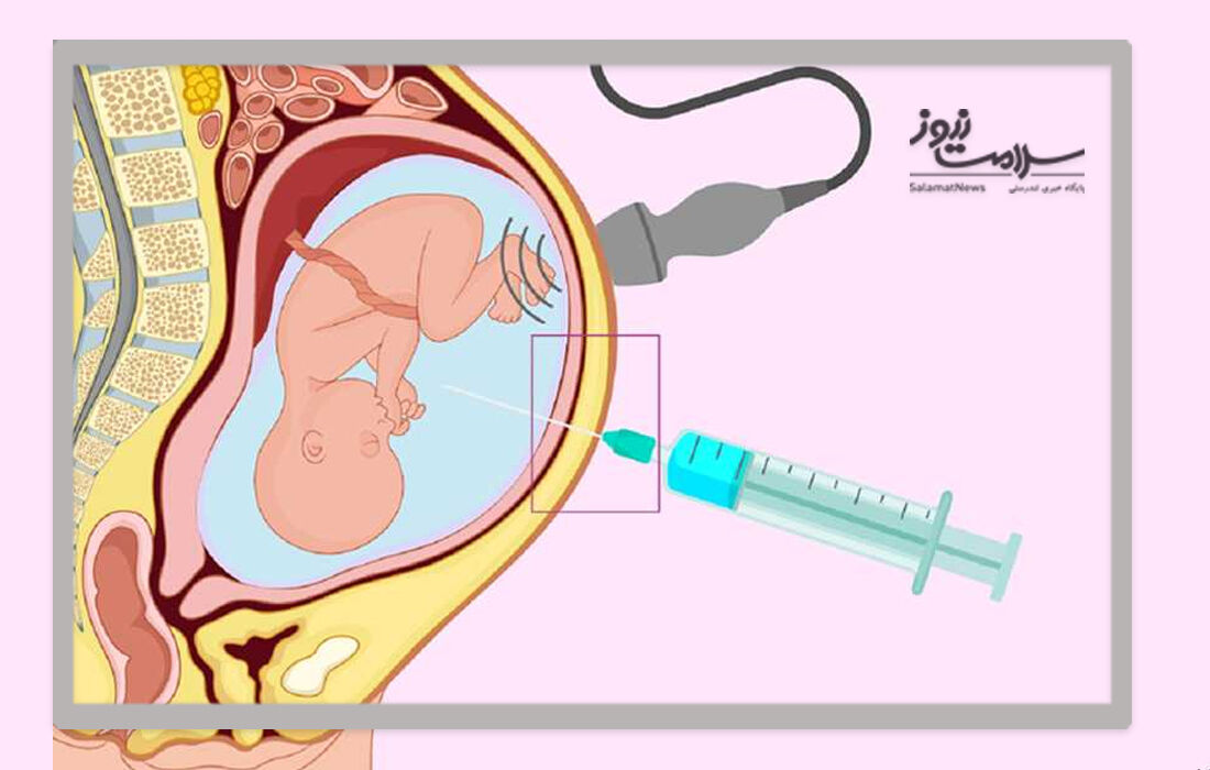 آمنیوسنتز چیست و برای کدام زنان باردار باید انجام شود؟