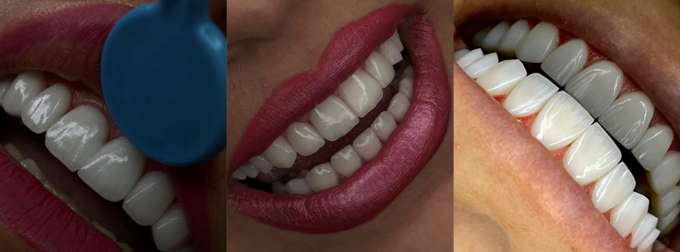 بهترین و سریع ترین روش های زیبایی دندان